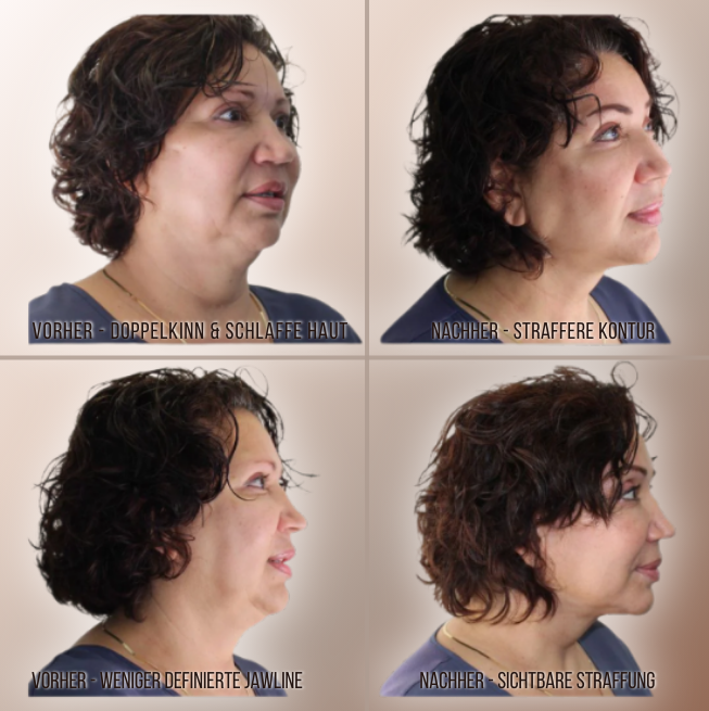 GlowTape™ – Straffes V-Shape in Sekunden